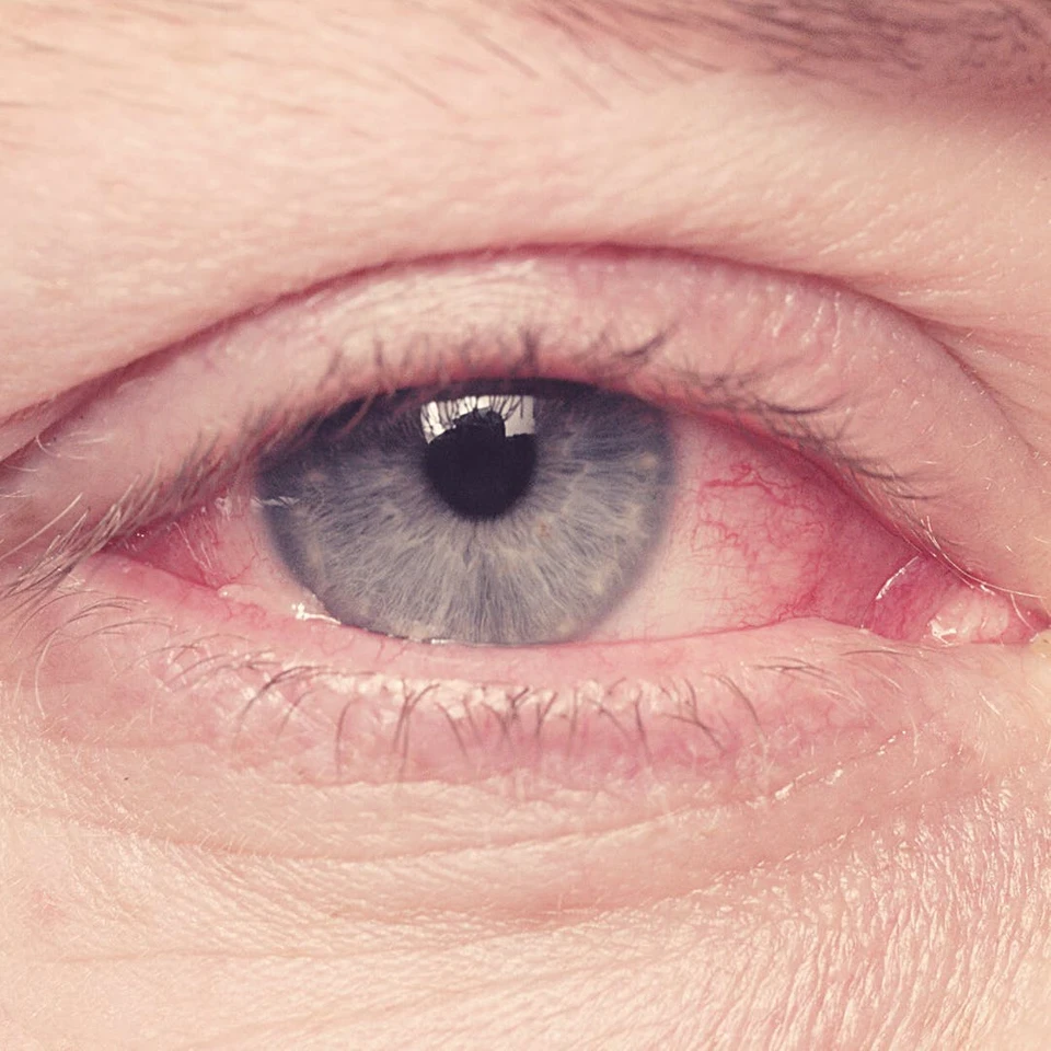 Do I Have Pink Eye Quiz - eyeFACTS