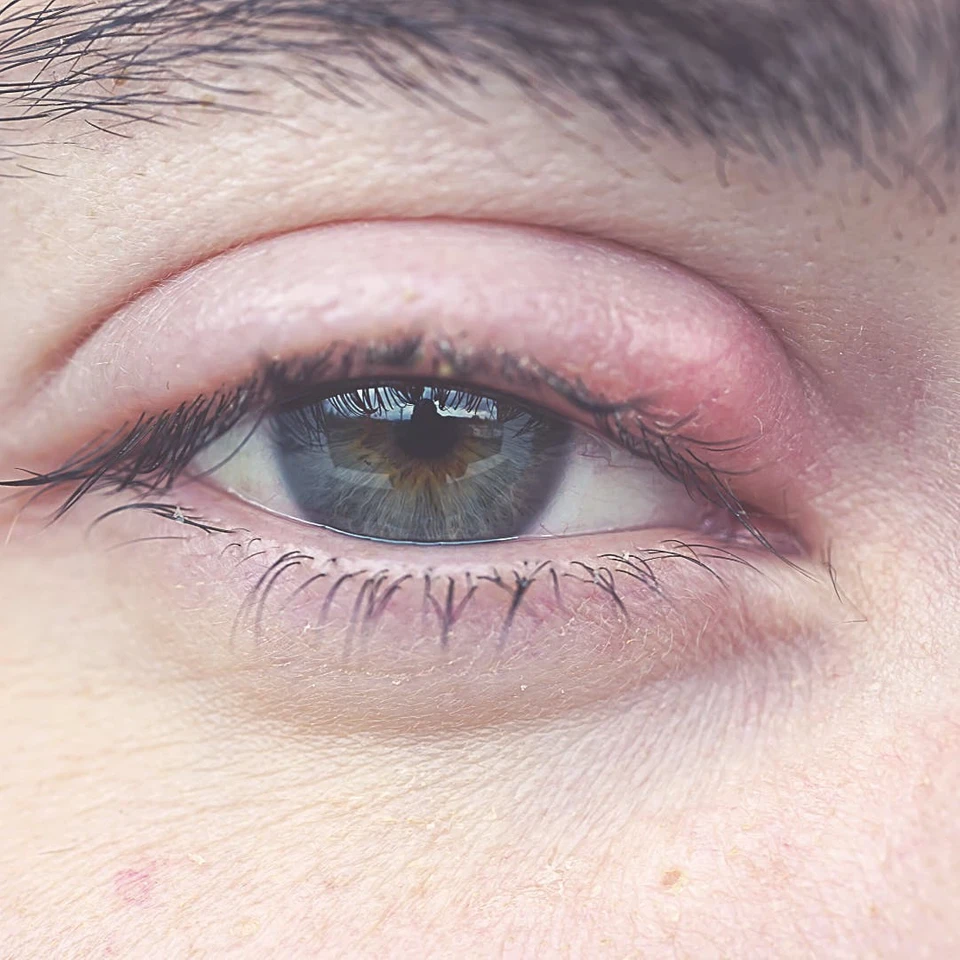 Chalazion Treatment : Top 5 Methods - eyeFACTS