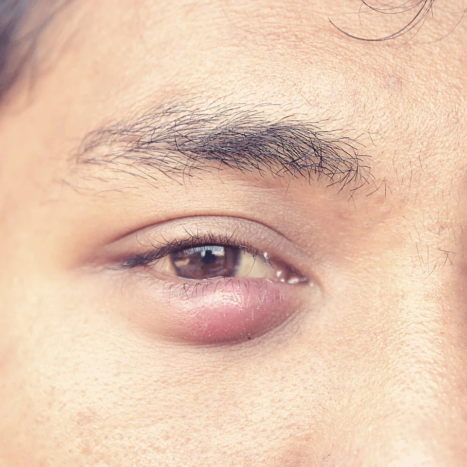 stye-vs-chalazion-eyefacts